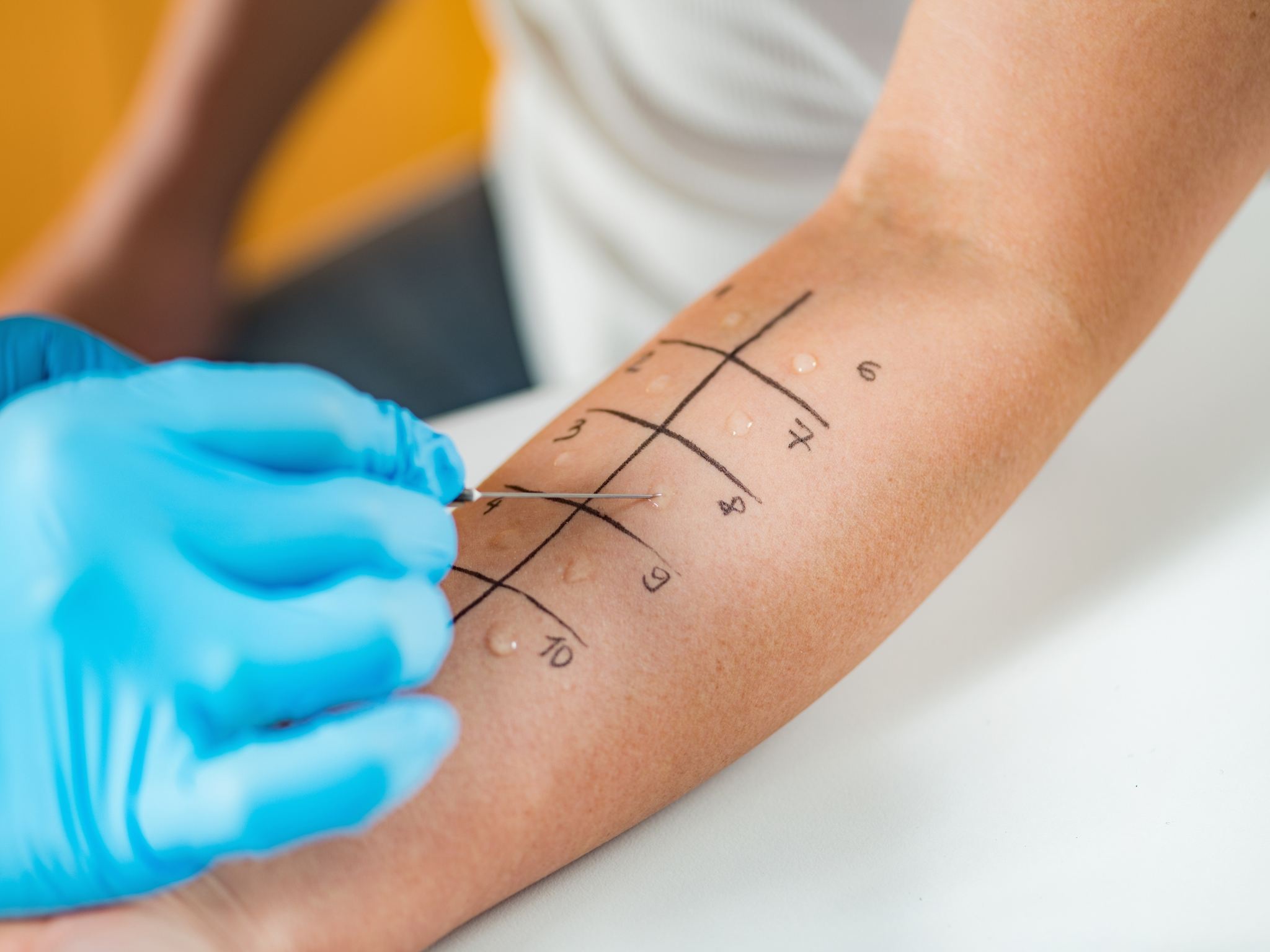 Esecuzione di un Prick Test cutaneo presso il centro di allergologia a Perugia per individuare allergie respiratorie e alimentari con l'allergologo a Perugia.