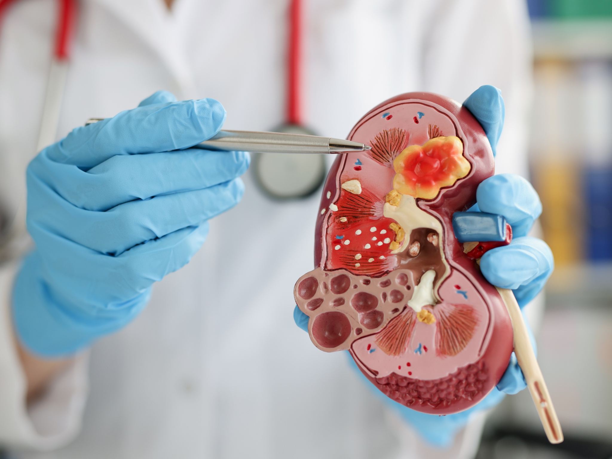 Nefrologo a Perugia degli Studi Medici San Nicolò durante un consulto per la prevenzione delle malattie renali.